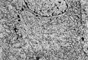 M, 54y. | pituitary adenoma - oncocytic M, 54y. | pituitary adenoma - oncocytic